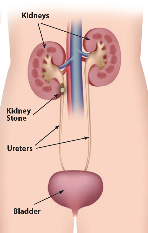 Image of human torso showing locations of kidneys, ureters and bladder and example of a location of a kidney stone. 