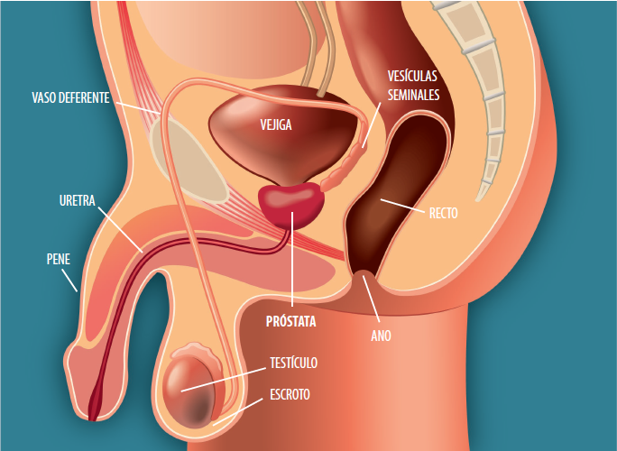 cancer prostata etapa 6