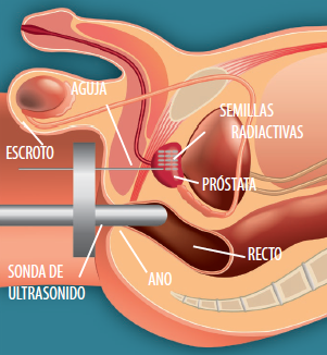 Clinica Polisano » Cancerul de prostată