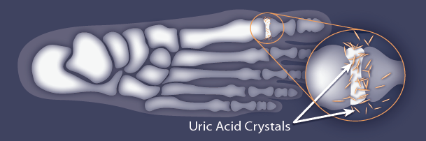 Image of foot with uric acid crystals in joint of big toe
