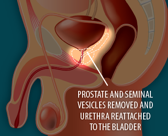 Image showing after surgery to remove the prostate gland, with prostate and seminal vesicles removed and urethra reattached to the bladder.