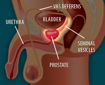 Image showing before surgery to remove the prostate gland.