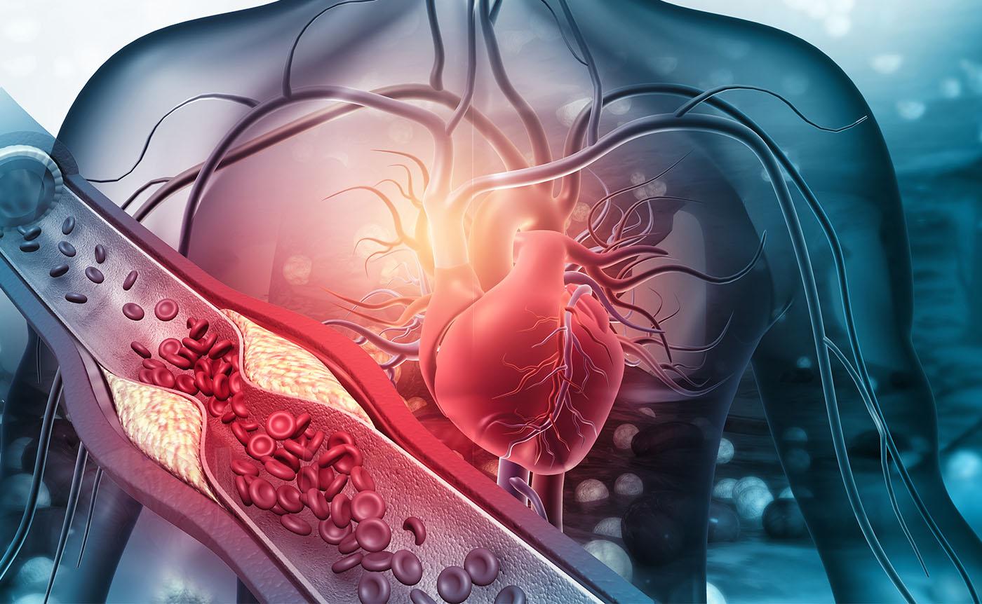 Nonemergent Percutaneous Coronary Intervention Versus Optimal Medical Treatment for Stable Ischemic Heart Disease: A Rapid Response Literature Review