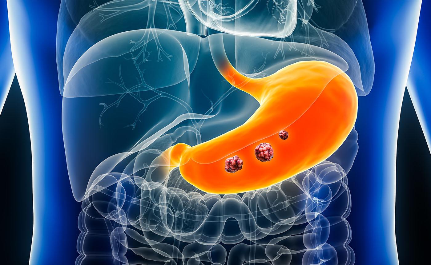 Stomach or gastric cancer