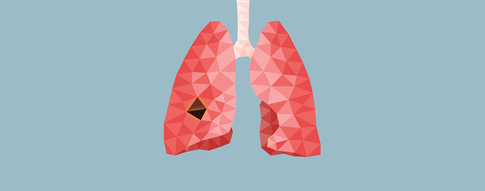 ¿Es la prueba para detectar el cáncer pulmonar apropiada para mí?