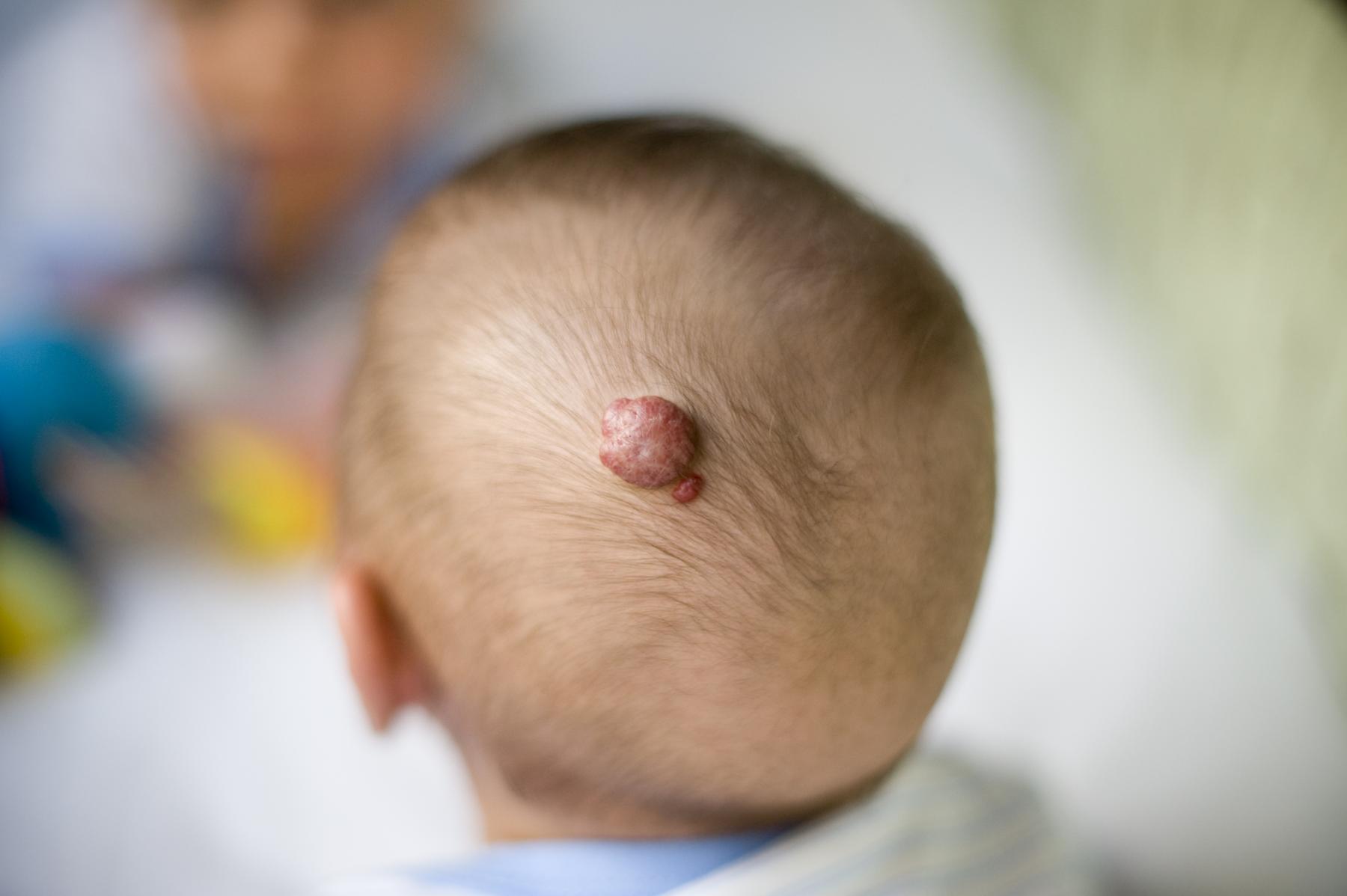 Tratamiento del hemangioma infantil en niños